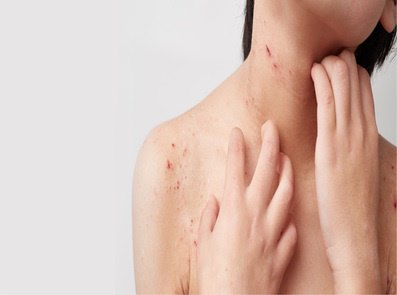 Atopic Dermatitis Image